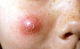 Заболевания кожи лица маски thumbnail
