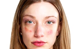 Красные шелушащиеся пятна на лице могут свидетельствовать о кожном заболевании