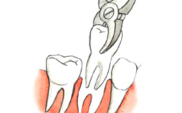 Отечность после удаления зуба считается нормой