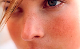 Как проявляется заболевание розацеа на лице