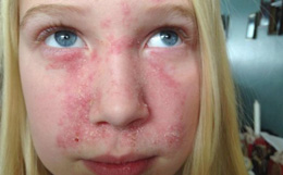 Симптомы и признаки появления дерматита на коже лица