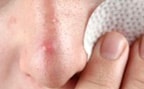 Болезни кожи лица противопоказания к бритью лица в салоне